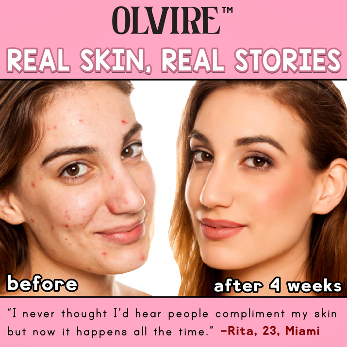 Olvire™ High Frequency Skin Therapy Wand