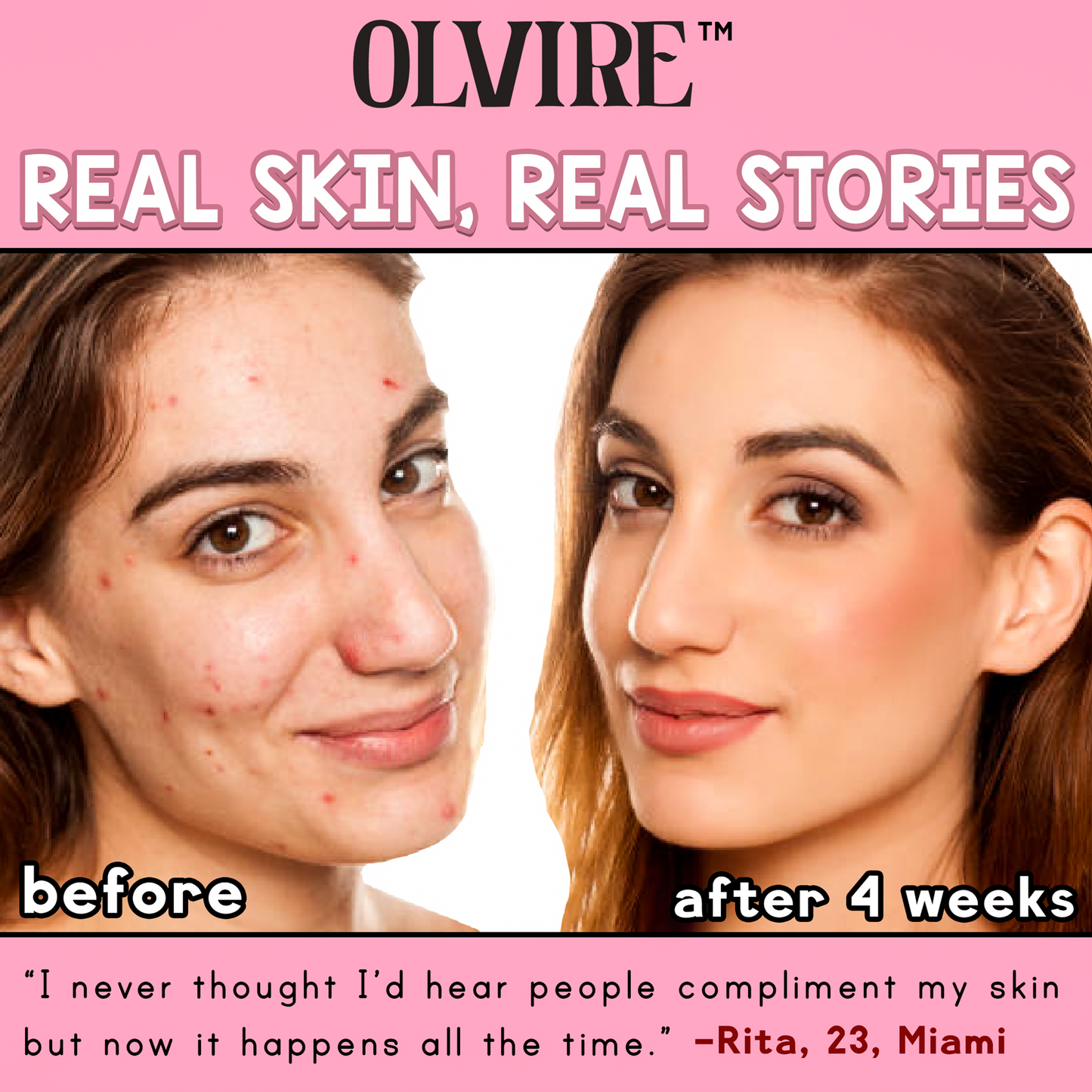 Olvire™ High Frequency Skin Therapy Wand